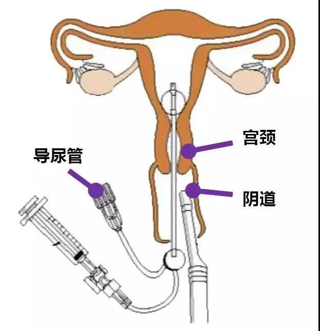 香港验血价格多少,岭南妇科养生坊｜超声照一照，就能知道输卵管通不通？零