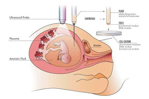 到香港验血要花多少钱啊,宫腔积液如何影响辅助生殖技术中助孕过程？